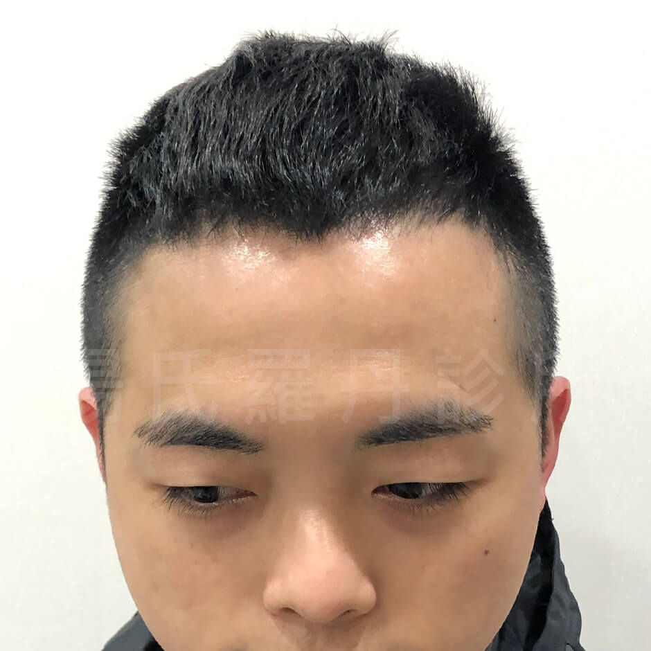 禿頭 植髮 楊氏羅丹 掉髮 生髮613